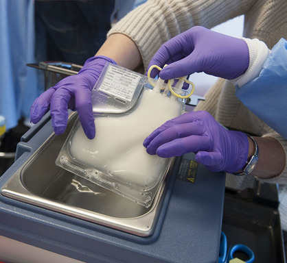 University of Pennsylvania researchers developed a new cancer treatment that engineers cancer patients' own cells to attack their tumors. A bag of reprogramed cells is shown here, ready for infusion.