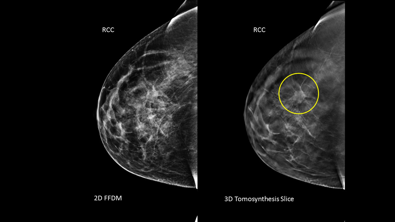 A 46 y/o woman presents for yearly screening mammography. The 3D mammogram revealed a 15 mm mass (see circle), which is hidden on the standard 2D mammogram. Biopsy revealed invasive ductal carcinoma.