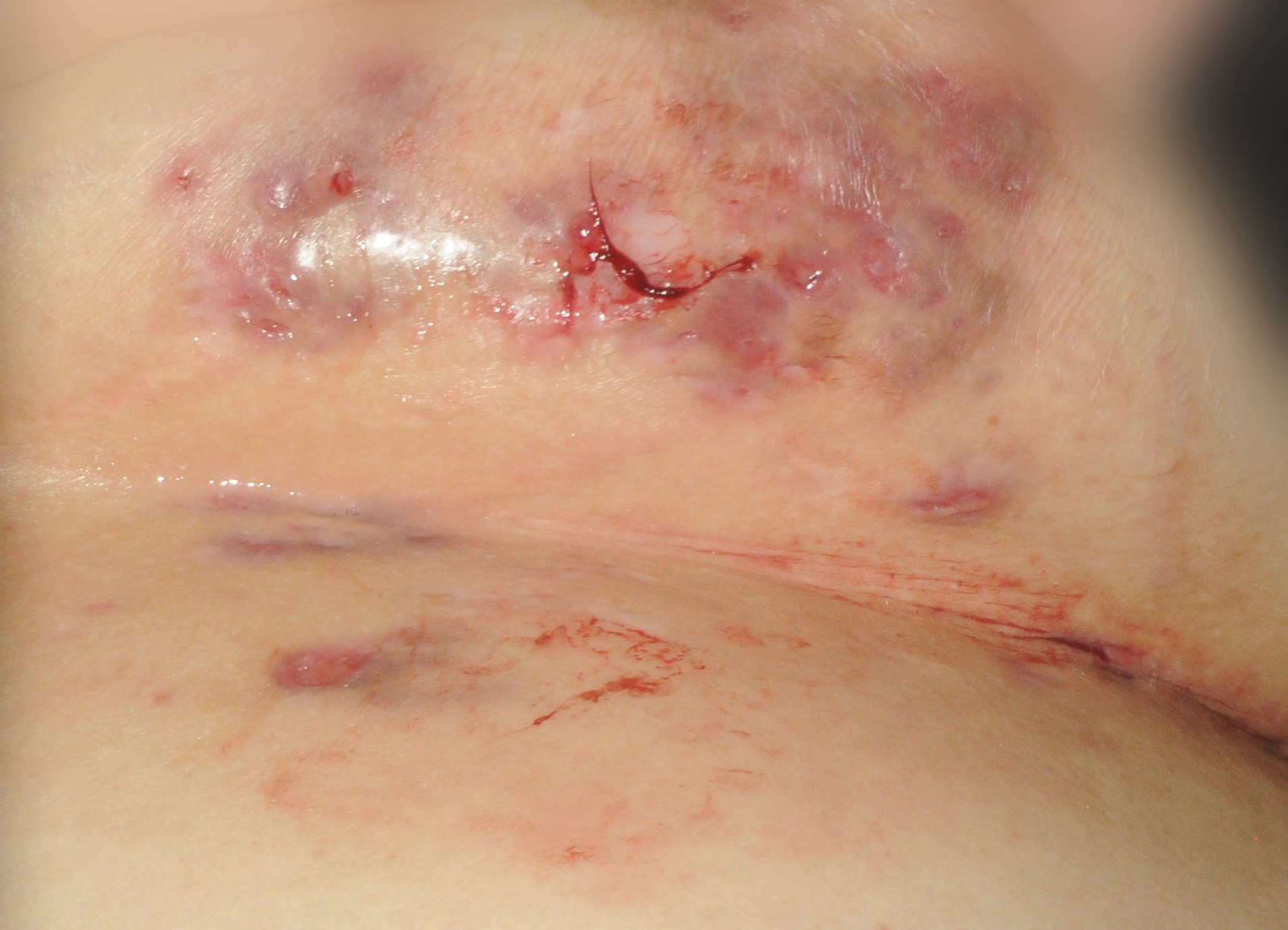 Severe Case of Hidradenitis Suppurativa Located on the Breast of a Female Patient