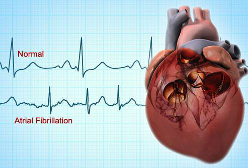 Irregular heartbeat vs. normal heartbeat