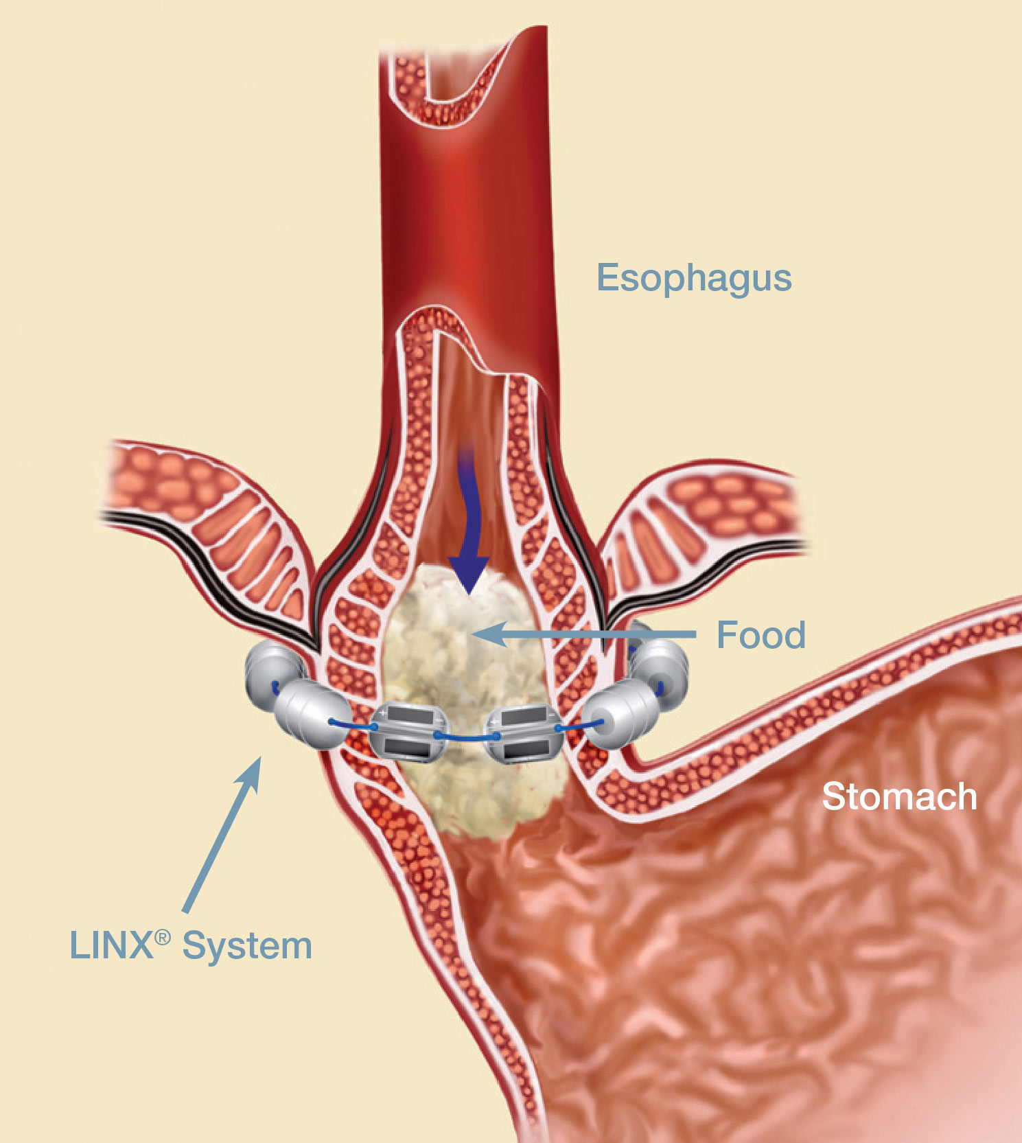 The LINX system is implanted through a one-time, minimally invasive surgical procedure to relieve symptoms associated with GERD.