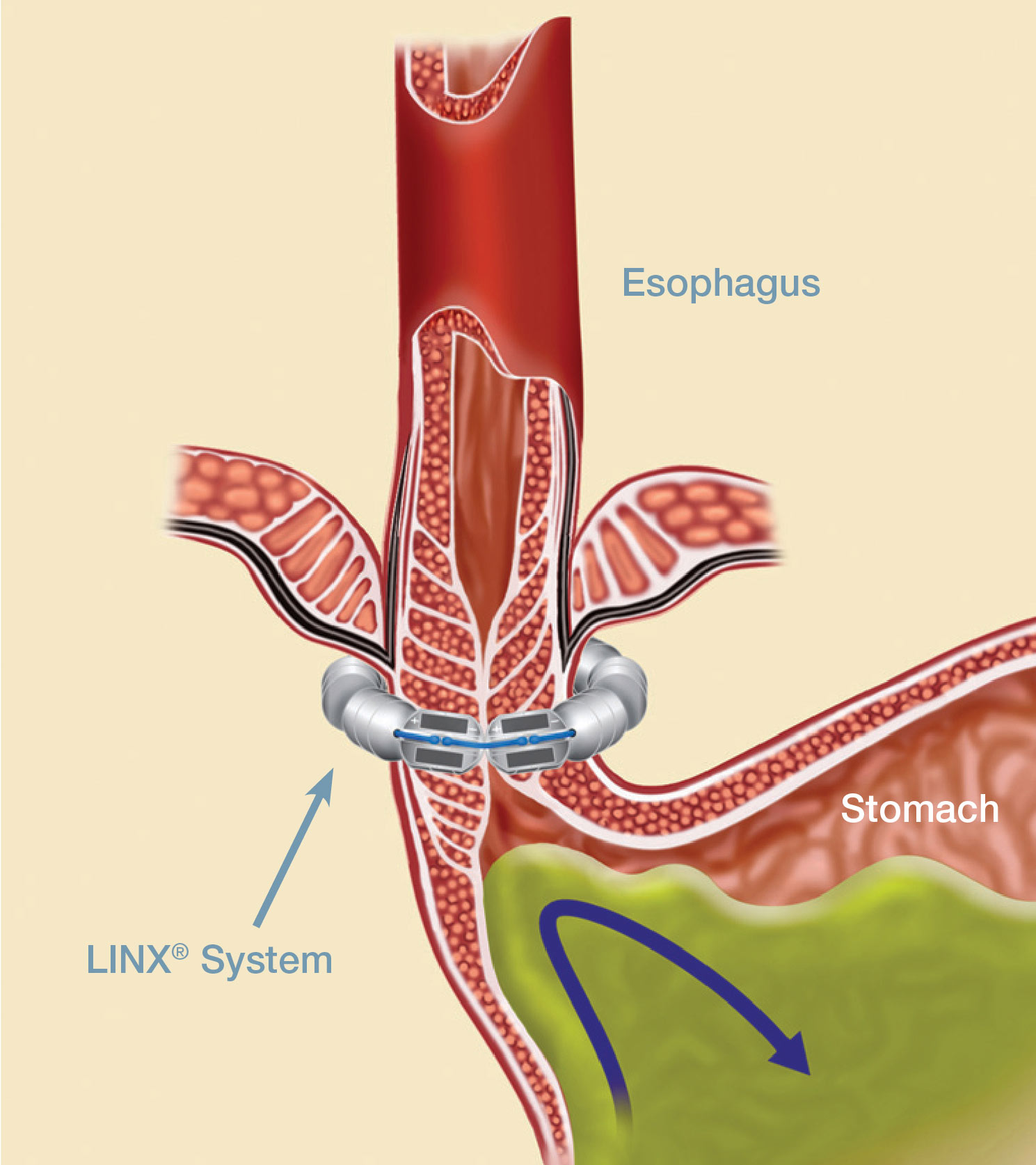 The LINX device, approved by the FDA in early 2012, is currently the only medical device approved by the FDA to be safe and effective for the treatment of gastro-esophageal reflux disease (GERD).
