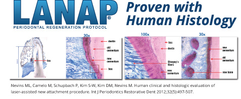 Illustrative graphic of the major steps in the LANAP/LAR protocol for periodontal True Regeneration.