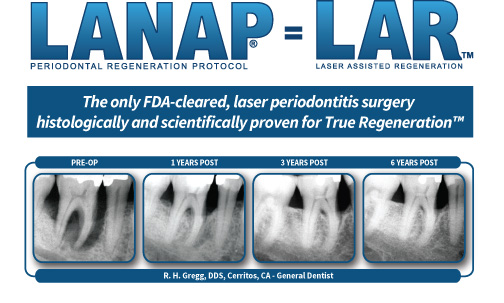 Thousands of clinicians and patients have benefited from the long-term, proven results provided by the LANAP protocol. These x-rays are a typical case of amazing periodontal healing.