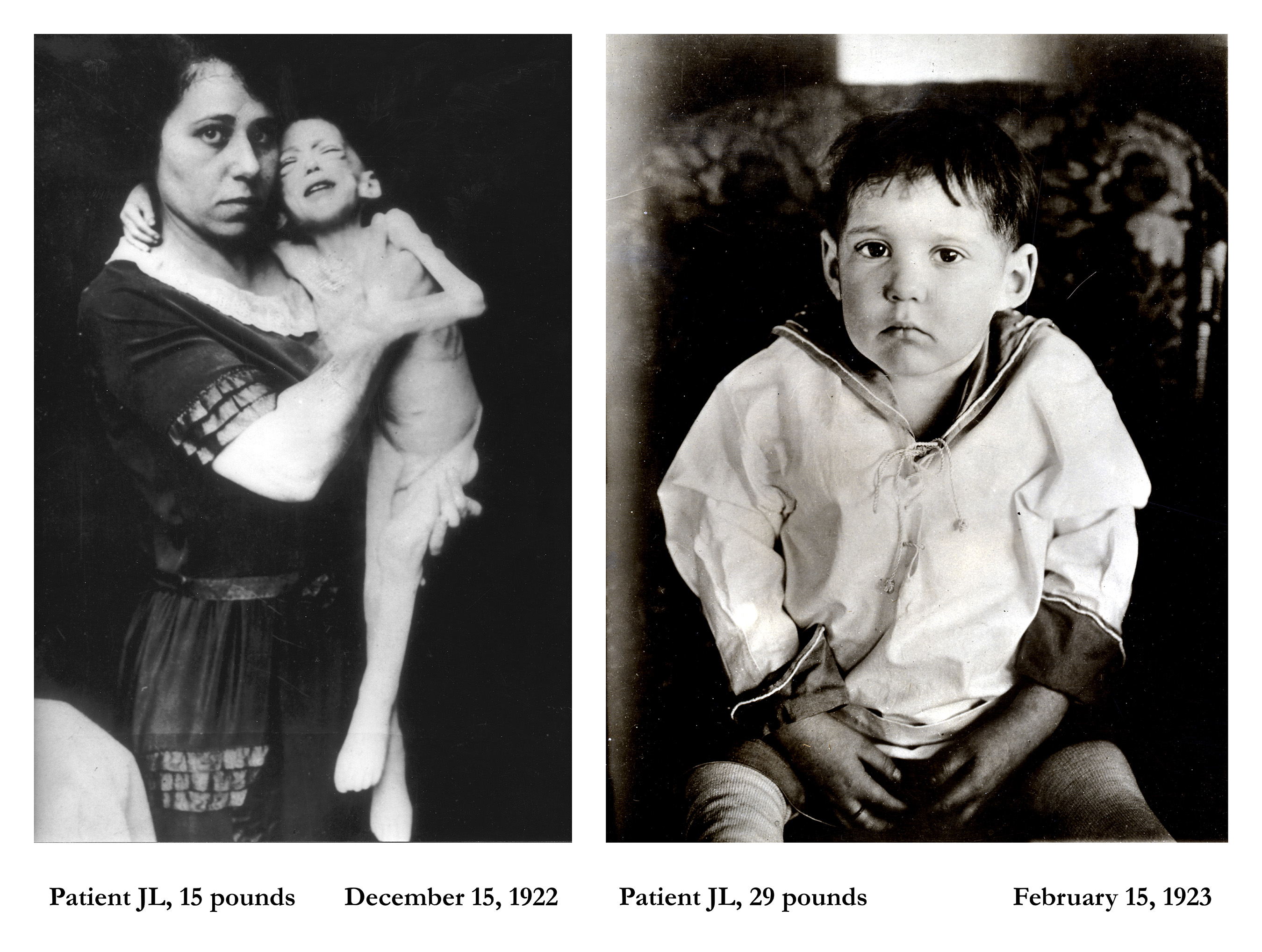 Less than 100 years ago, diabetes was a fatal disease with no treatment other than starvation. In 1923, Lilly collaborated with Canadian scientists Dr. Frederick Banting and Charles Best to overcome production challenges to introduce the world’s first commercial insulin product. Featured in this photo is J.L., a child with diabetes before, then two months after, taking insulin.