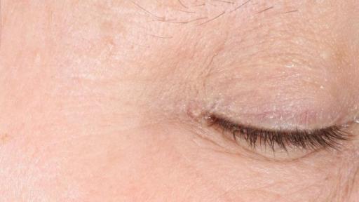 Exuviance HA100 Micro-Filler Regimen After 4 Weeks