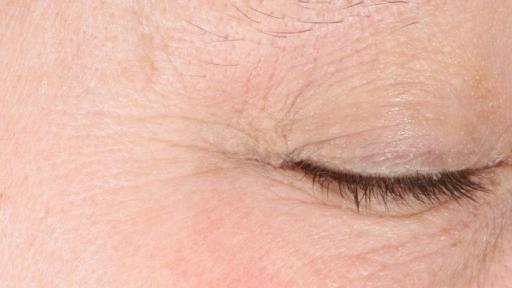 Exuviance HA100 Micro-Filler Regimen Before