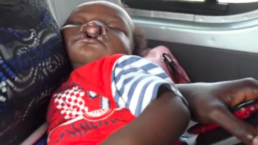 Boy with a cleft palette, on mothers lap.