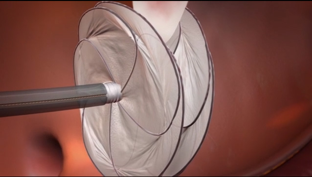 Video animation of the GORE CARDIOFORM Septal Occluder