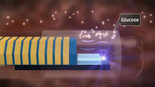 Animation of Eversense Continuous Glucose Monitoring System (CGM)
