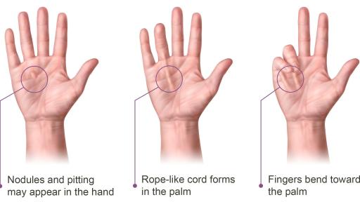 Infographic with three hands showing the progression of Dupuytren's Contracture.