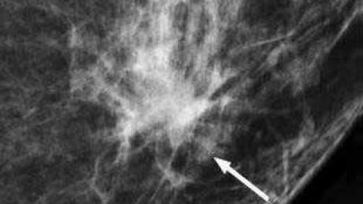 Invasive ductal carcinoma identified by mammogram