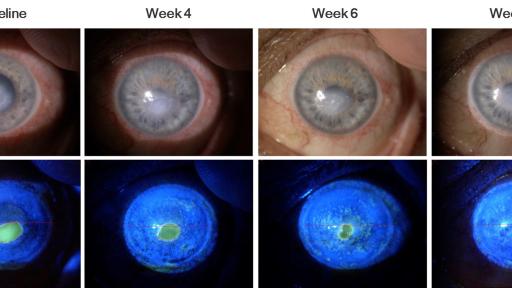 Bonini S, Lambiase A, Rama P, Sinigaglia F, Allegretti M, Chao W, Mantelli F, for the REPARO Study Group. Phase II Randomized, Double-Masked, Vehicle-Controlled Trial of Recombinant Human Nerve Growth Factor for Neurotrophic Keratitis. Ophthalmology. 2018;125:1332-43.