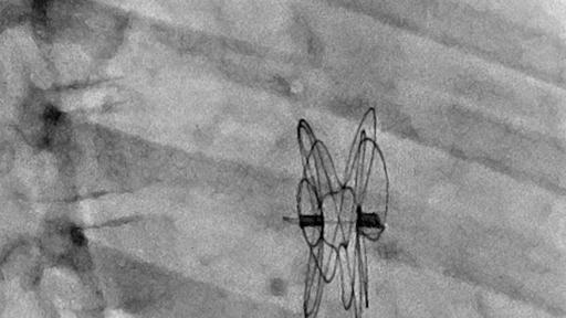 Xray imaging of Fluoroscopy