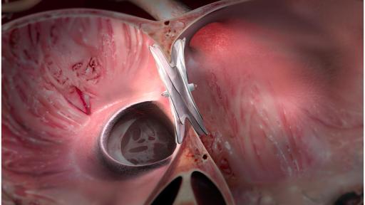 Medical Illustration - GORE&reg; CARDIOFORM ASD Occluder in the heart