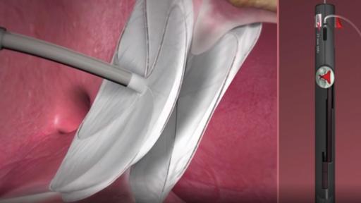 Play Video: Animation - GORE&reg; CARDIOFORM ASD Occluder