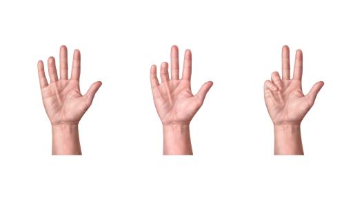 Stages of Dupuytren’s Contracture