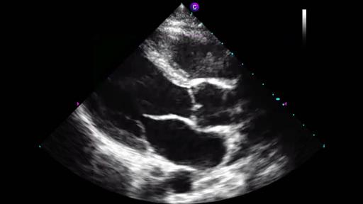 An apical four-chamber view of the heart captured by Caption AI.
