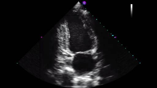 An apical two-chamber view of the heart captured by Caption AI.
