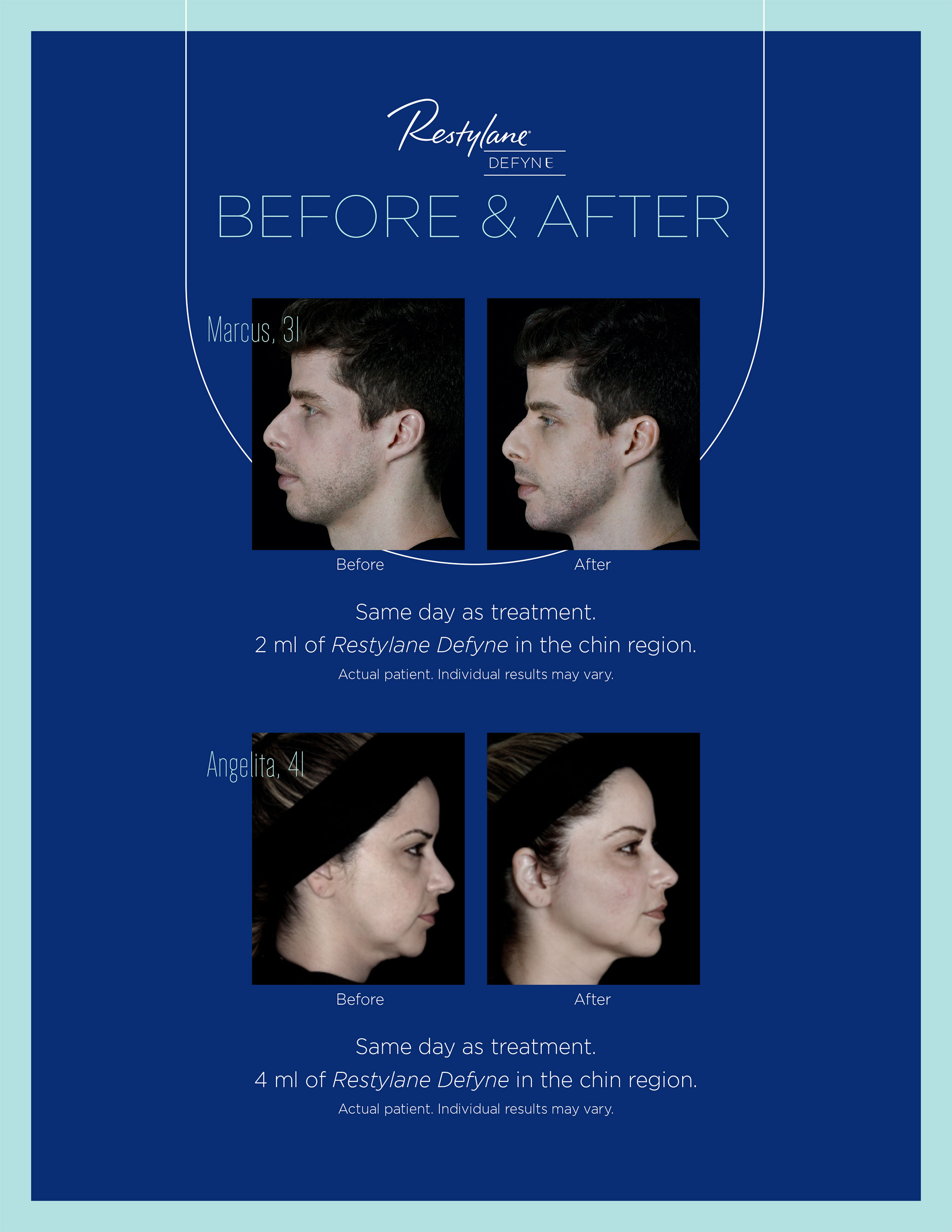 Restylane® Defyne B&A