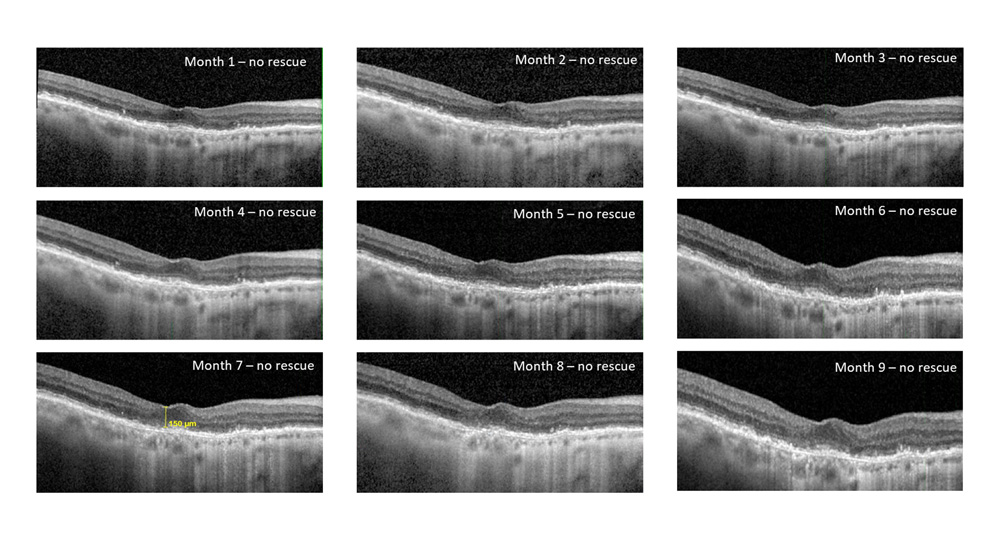 Patient 1: Post-treatment OCT’s showing no fluid reaccumulation after a single injection of EYP-1901
