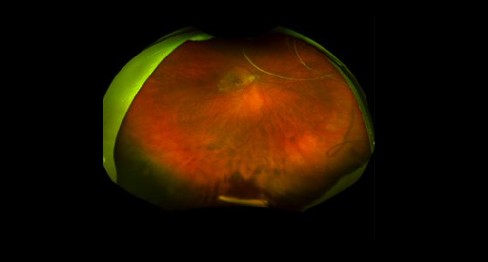 EmbedEYP-1901 insert at month five post-injection