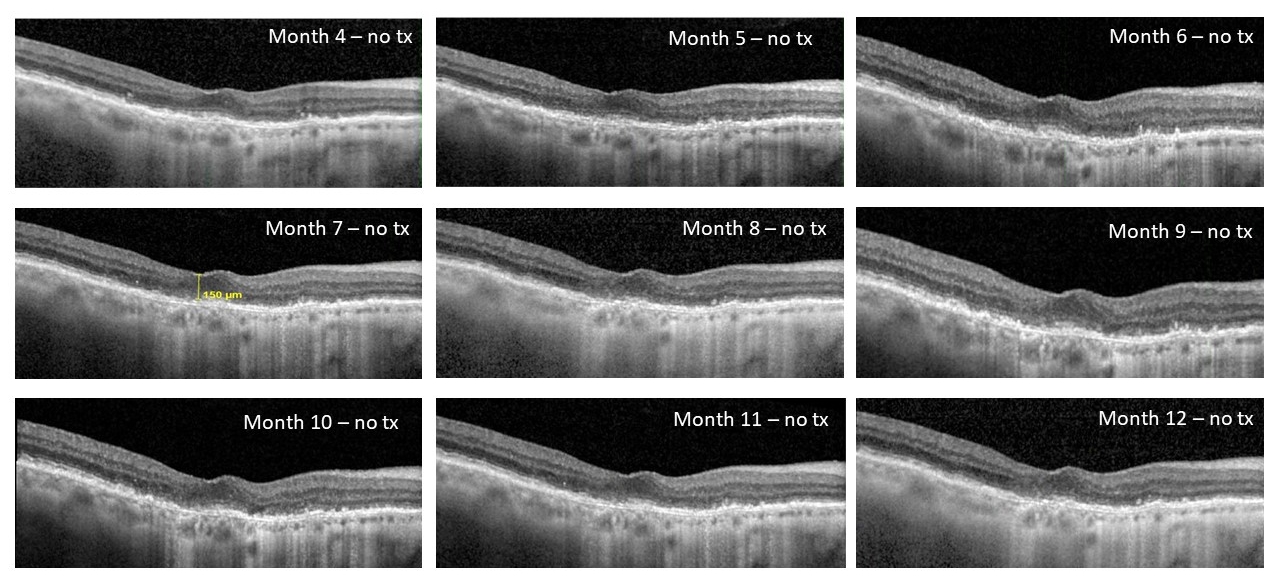 Patient 1: Post-treatment OCT’s showing no fluid reaccumulation after a single injection of EYP-1901 through month 12
