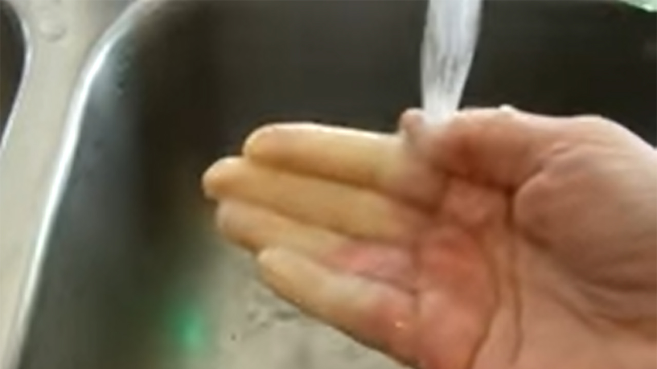 Play Video: Raynaud's Phenomenon in Real Time Video