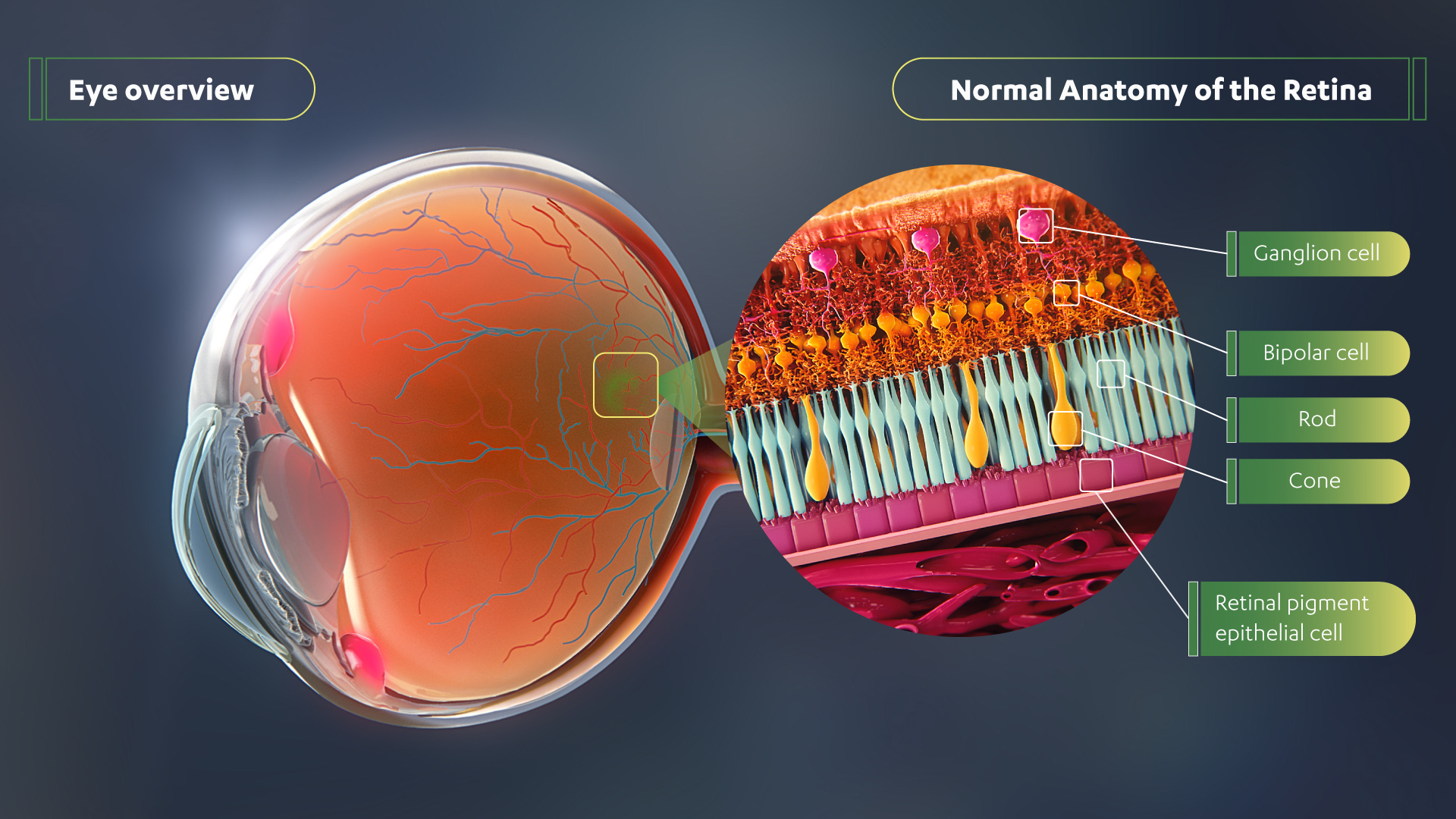 Eye Overview. Normal Anatomy of the Retina. A multicolored diagram showing the inside of the Retina in orange and a close up of the Ganglion cells (pink), Bipolar cells (orange), Rods (blue), Cones (yellow) and Retinal pigment epithelial cell (maroon).