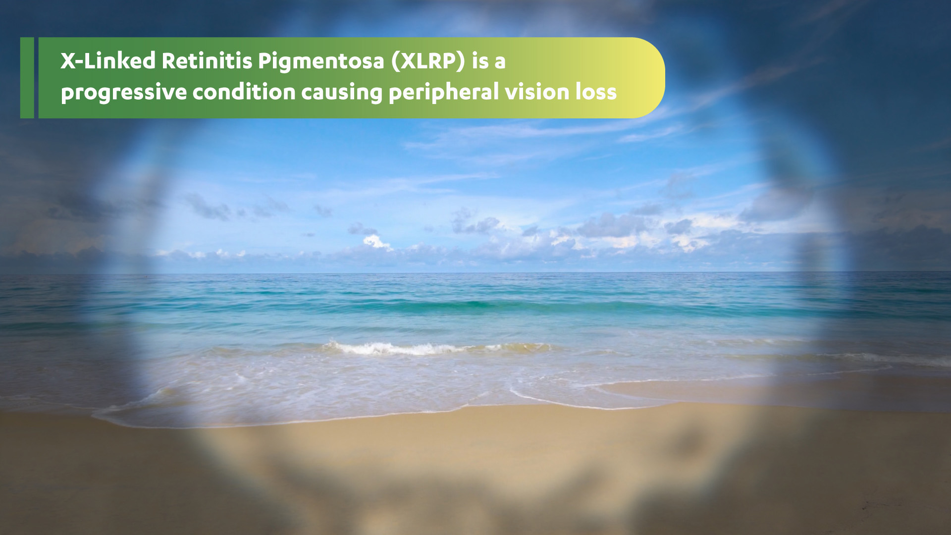 X-linked retinitis pigmentosa is a progressive condition causing peripheral vision loss: Photo of a beach with clear blue water on a sunny day showing the darkening and blurring of the outer ring of peripheral vision.