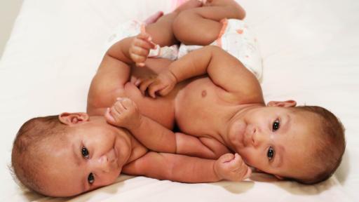 Conjoined Twins Hamad & Tamim prior to separation surgery at Sidra Medicine in Qatar
<br>
التوأم الملتصق حمد وتميم قبل عملية الفصل في مركز سدرة للطب في قطر.