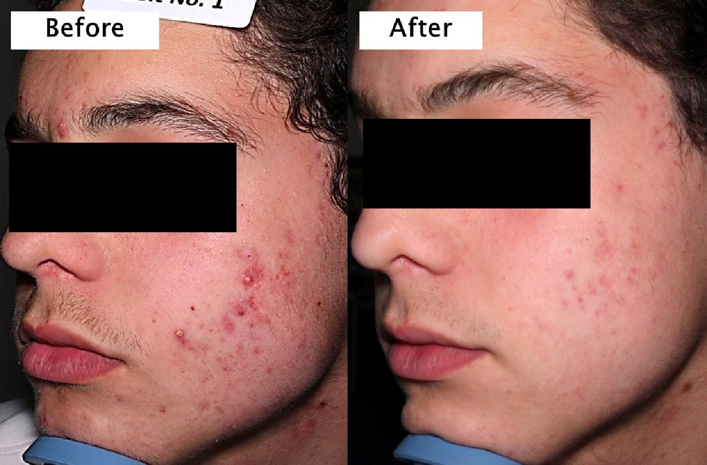 Doxycycline acne treatment results, how to have nice skin naturally