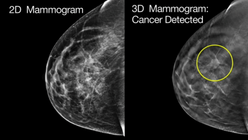 3D Mammography (Breast Tomosynthesis)