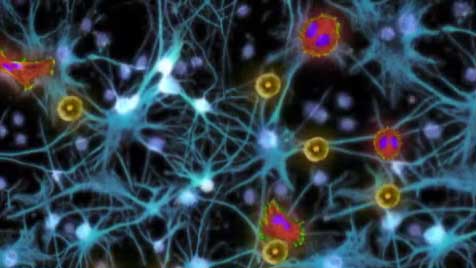 Cold Virus, Stem Cells Tested To Destroy Deadly Brain Cancer