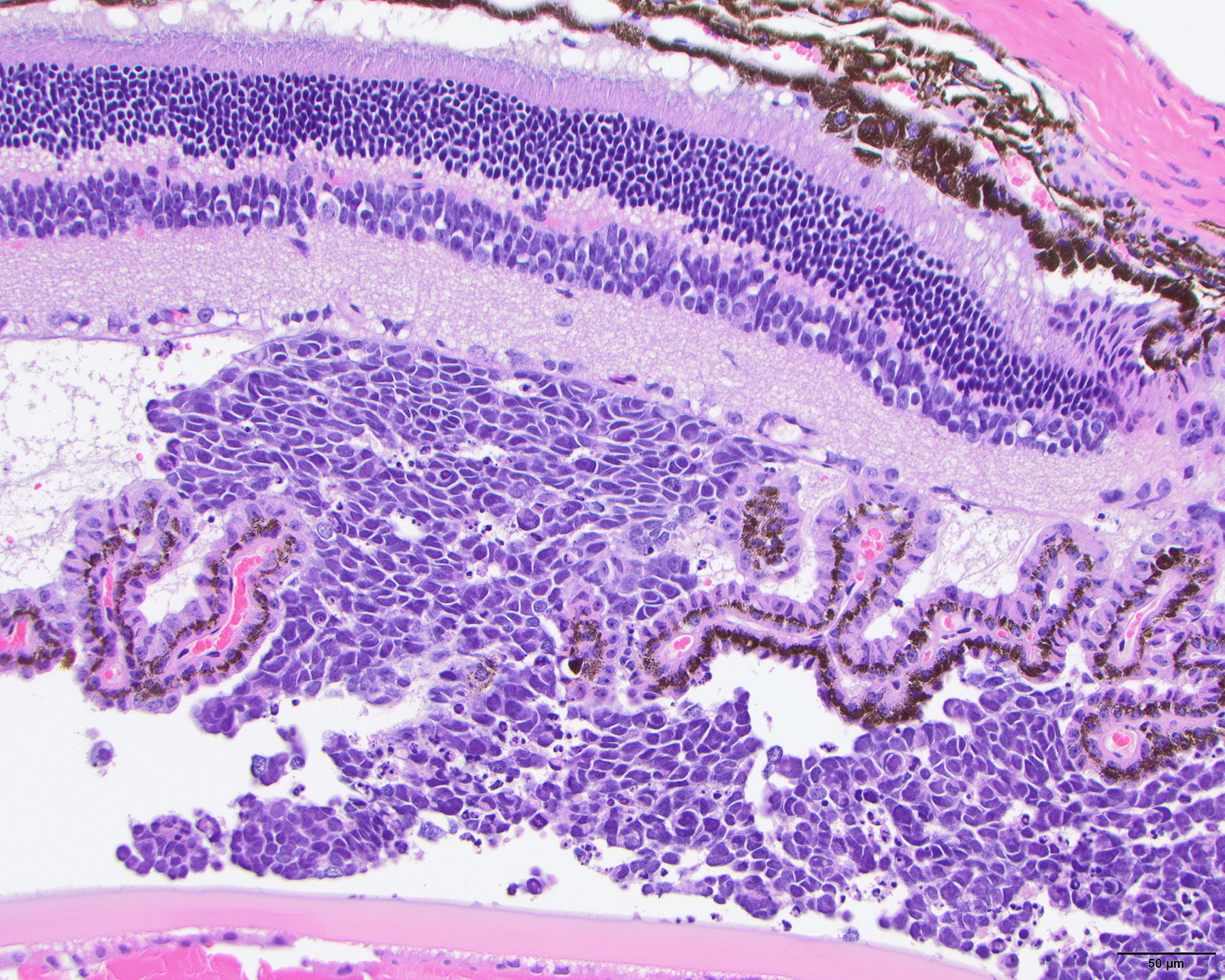 This stained image represents a retinoblastoma sample, much like researchers and physicians can request. The top section of the image is the retina, followed by xenografted retinoblastoma cells.