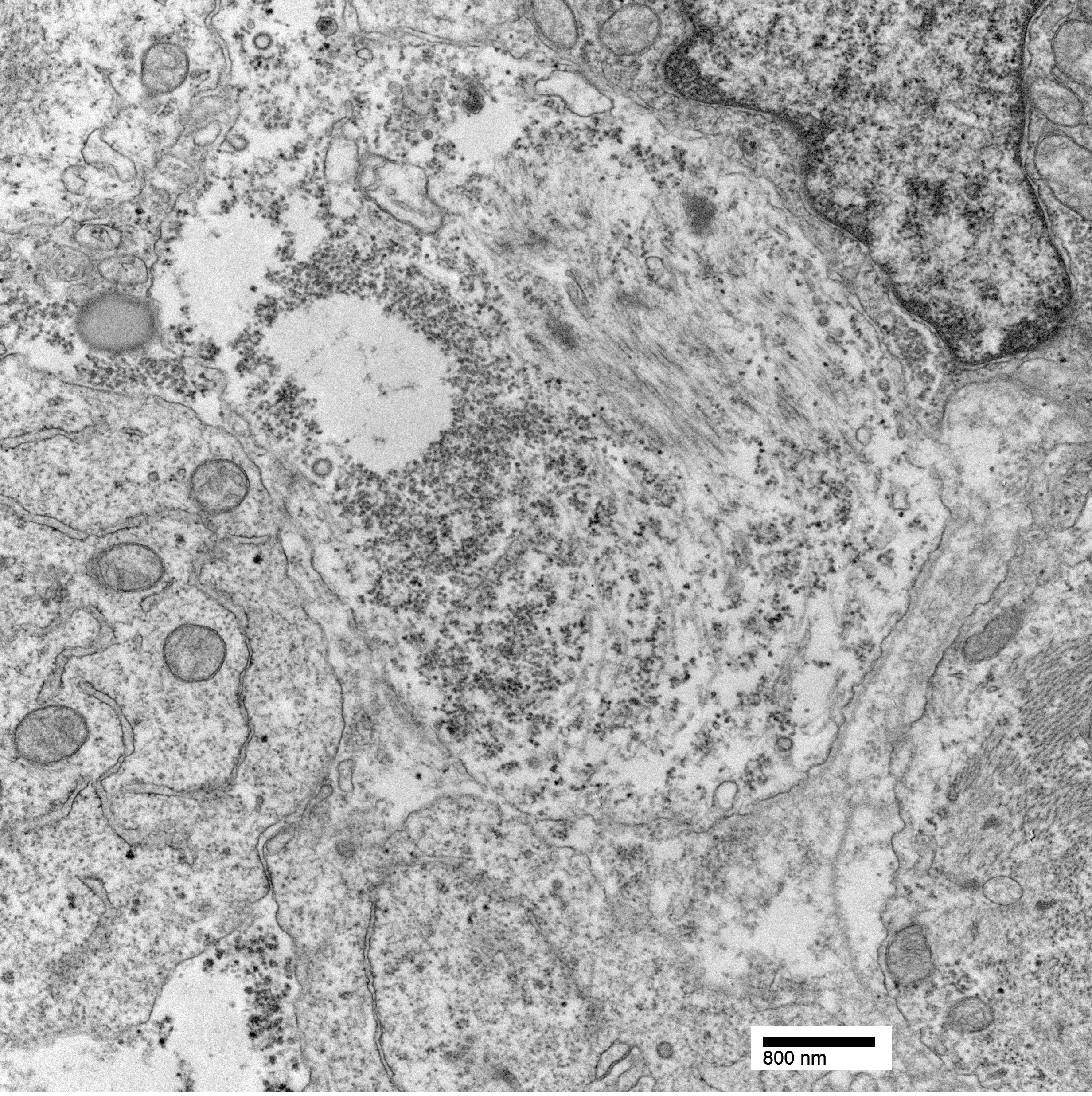This electron microscopy image depicts one of the available tumors from the CSTN. In this image, a cell nucleus in the upper right corner of a sample of rhabdomyosarcoma has characteristic glycogen accumulation. Filaments are forming early z-bands (center), and lipid, basement membrane and tight junctions are also visible.