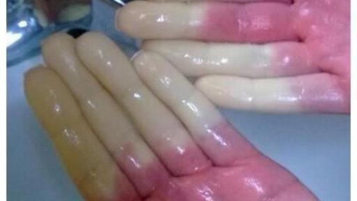 Color changes in the fingers are a common marker for Raynaud's Phenomenon
