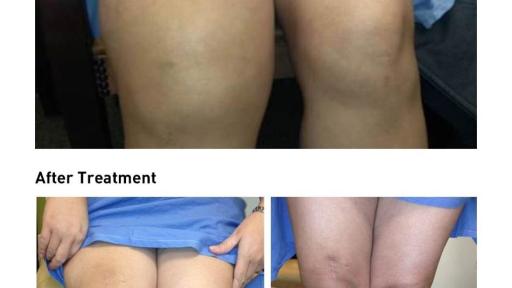 Photo of patient with TGCT affecting the knee
