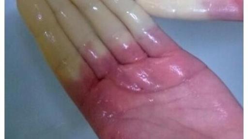 Color changes in the fingers are a common marker for Raynaud's Phenomenon