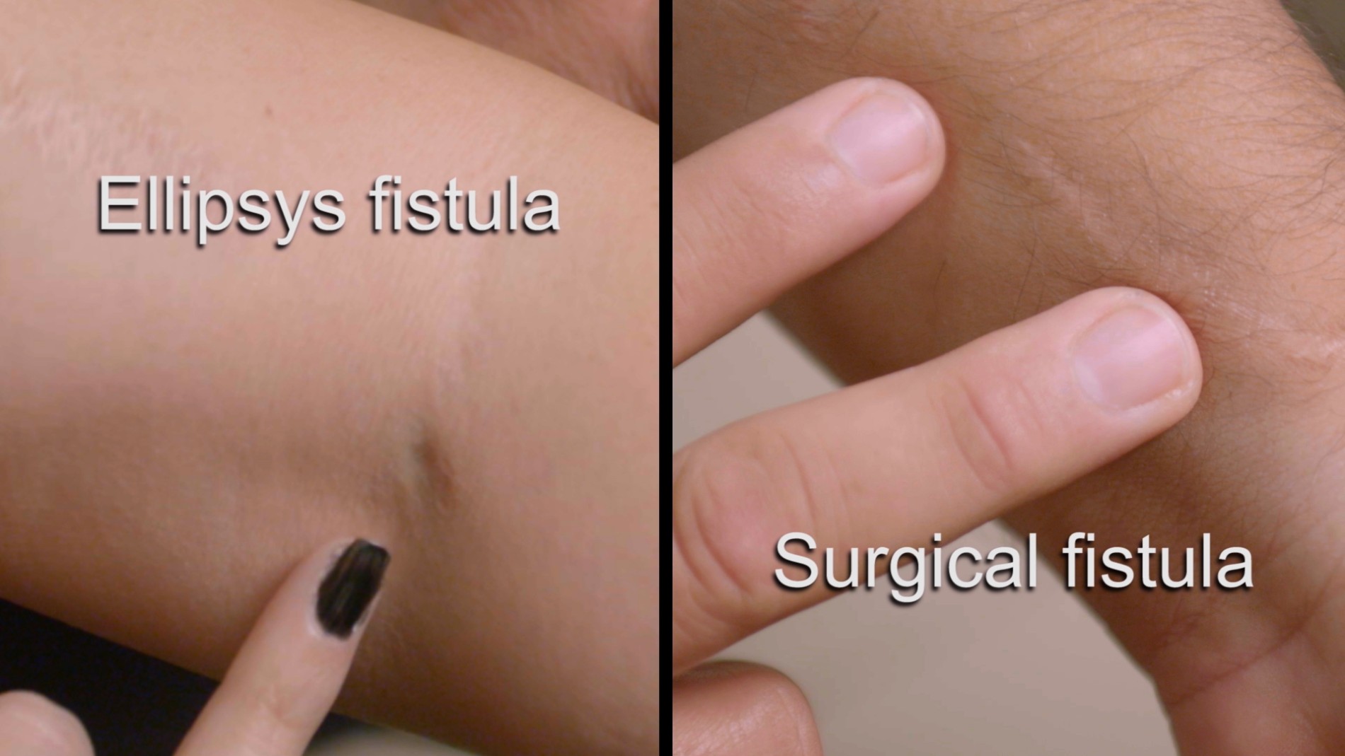 Ellipsys Fistula and Surgical Fistula