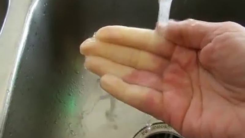 Play Video: Real Time Raynaud’s Attack