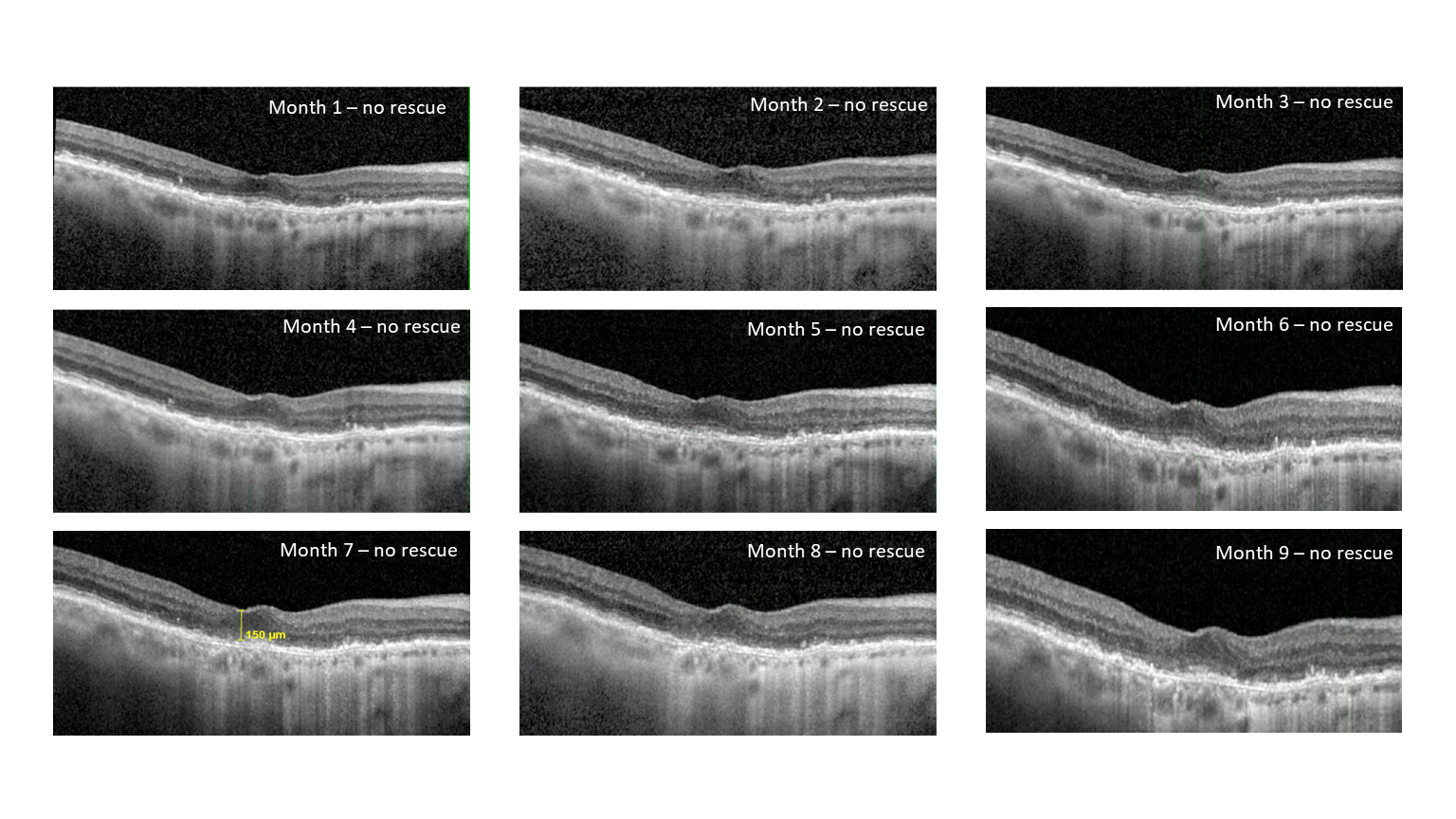 Patient 1: Post-treatment OCT’s showing no fluid reaccumulation after a single injection of EYP-1901