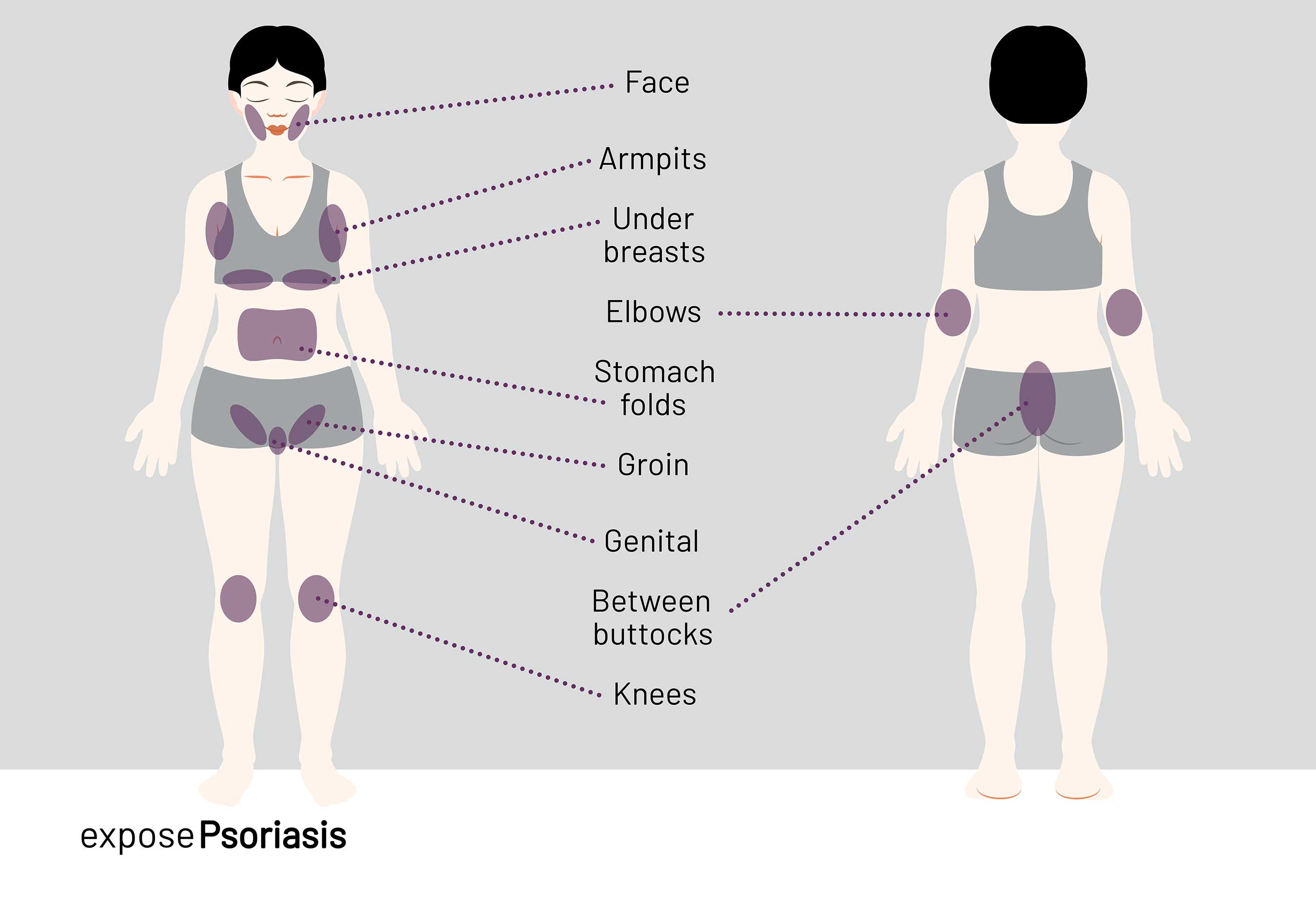 Psoriasis can occur anywhere, including the knees, elbows, torso and sensitive places like the face, genitals and areas where skin touches skin (intertriginous areas).