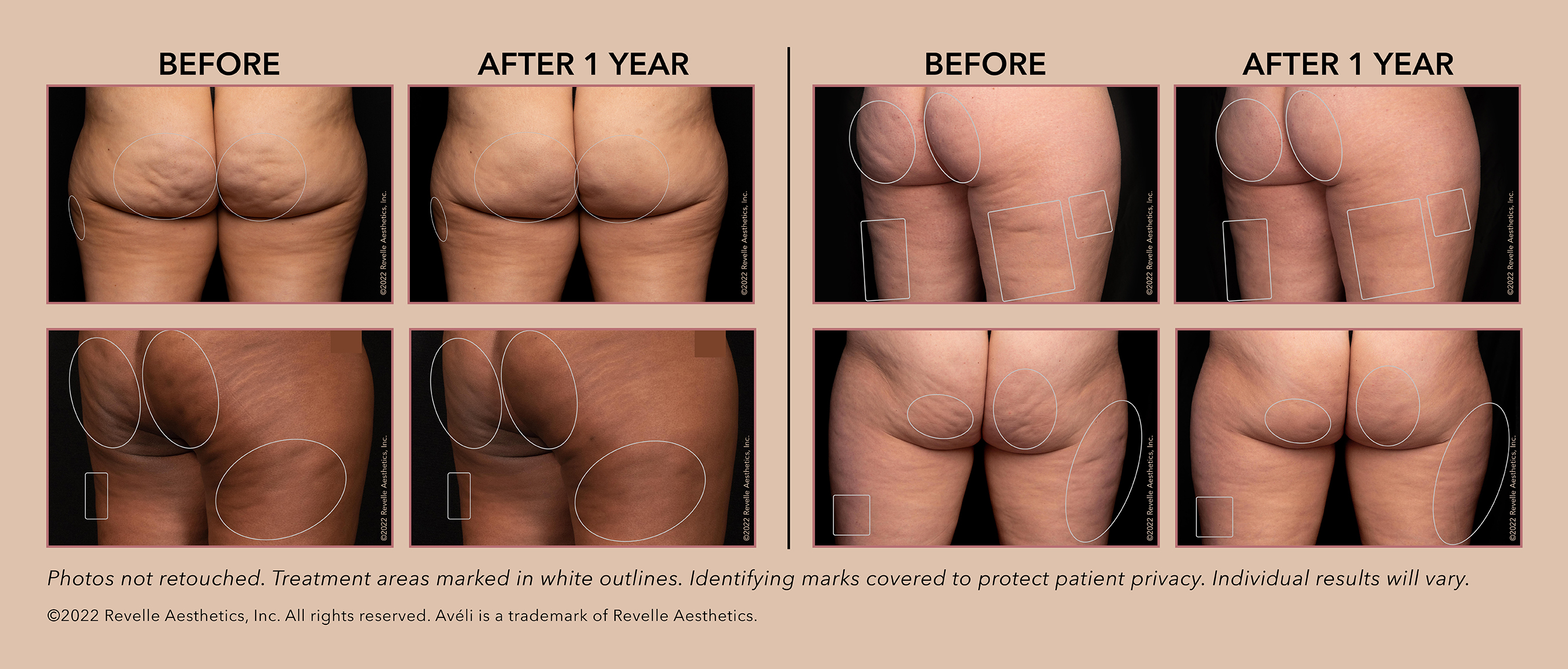 Aveli™ delivers long-lasting cellulite reduction in the buttocks and thighs after a single procedure. After photos demonstrate durable results at one year post procedure. Photos not retouched. Treatment areas marked in white outlines. Individual results will vary.