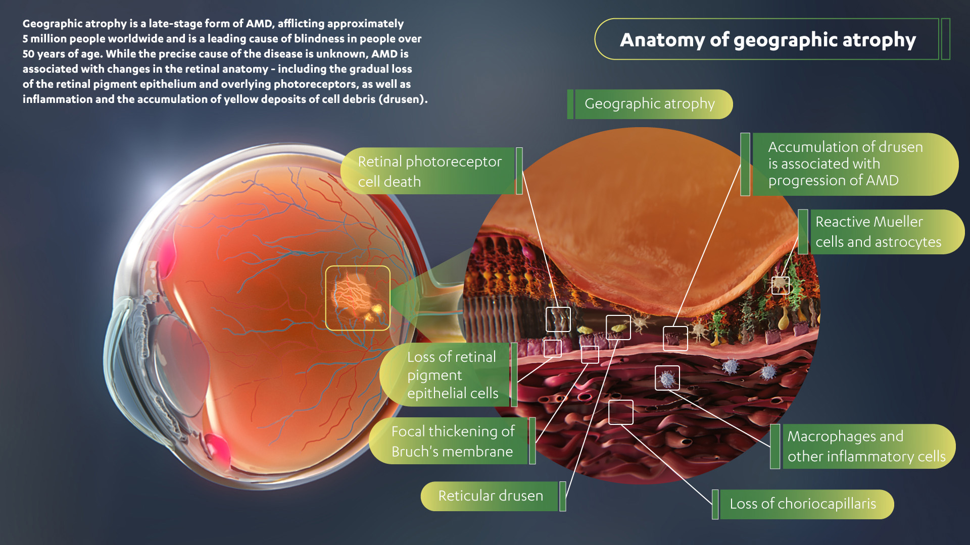 Multicolored anatomy of geographic atrophy in the retina. Shows retina photoreceptor cell death, loss of retinal pigment epithelial cells, focal thickening of Bruch's membrane, reticular drusen, loss of choriocapillaris, marcrophages and other inflammatory cells, the accumulation of drusen, and reactive Mueller cells and astrocytes.